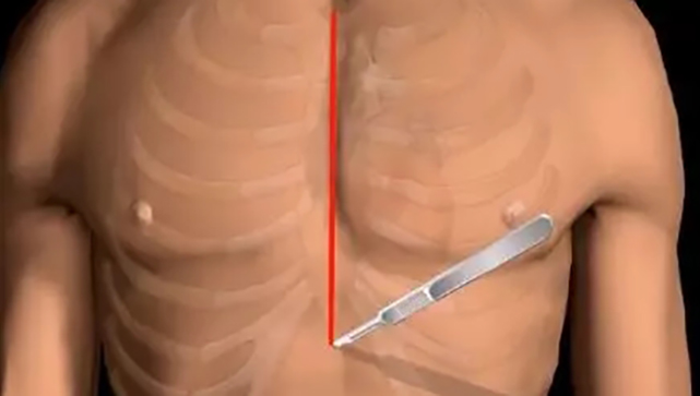 一文讀懂冠狀動脈搭橋術(shù)（系列二)